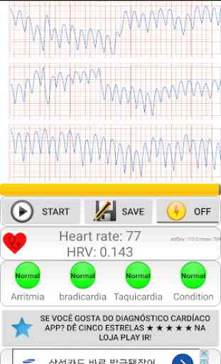 Diagnóstico cardíaco(arritmia) 3