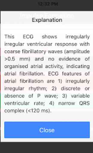 ECG Master: Electrocardiogram Quiz & Explanation 4