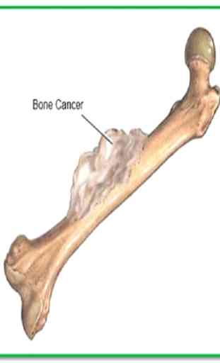 Câncer nos ossos 2