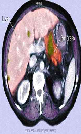 Câncer de pâncreas 3