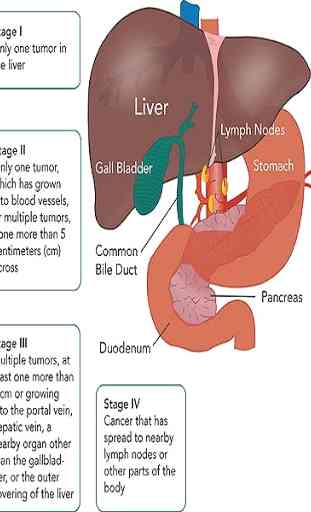 Câncer de fígado 2