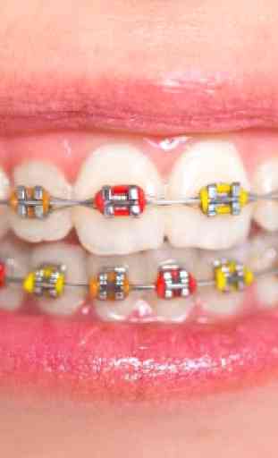 Real Braces Teeth 4