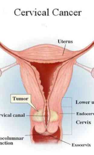 Câncer Cervical 4