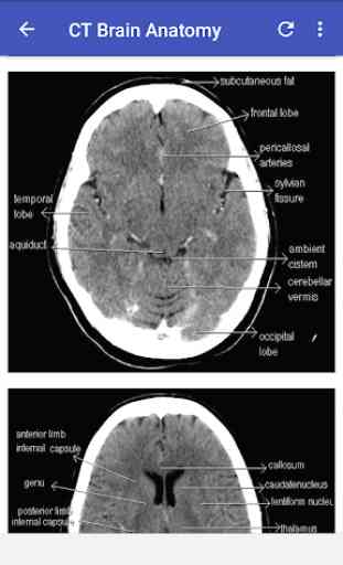 CT Brain Interpretation 3