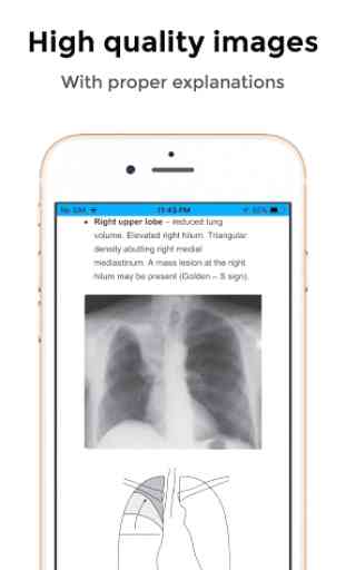 CXR FlashCards - Reference app for Chest X-rays 1