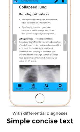 CXR FlashCards - Reference app for Chest X-rays 2