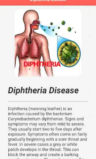 Diphtheria Disease 4