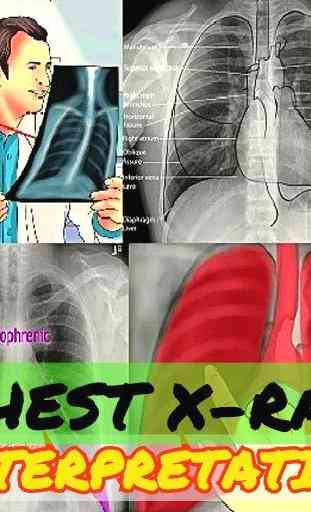 The Basics Of Chest X-Ray Interpretation 2