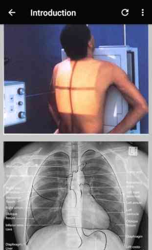 The Basics Of Chest X-Ray Interpretation 3