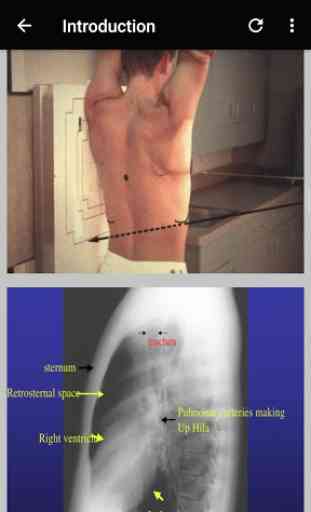 The Basics Of Chest X-Ray Interpretation 4