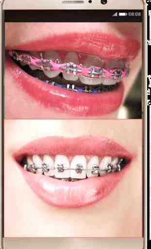 Braces Photo Editor - Braces For Your Teeth 3
