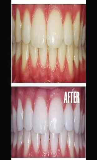 Recipes for teeth whitening 2