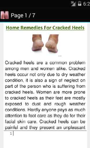 Get Rid of Cracked Heels 2