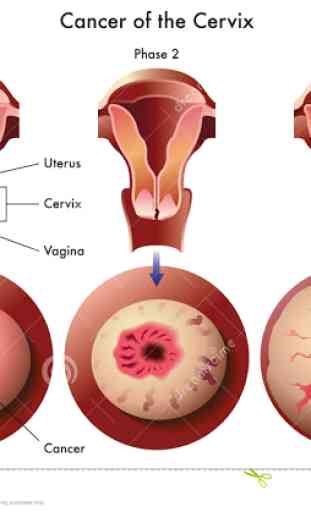 Cervical Cancer - News/Videos 1