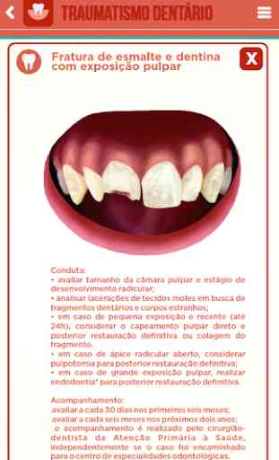 Traumatismo Dentário 2
